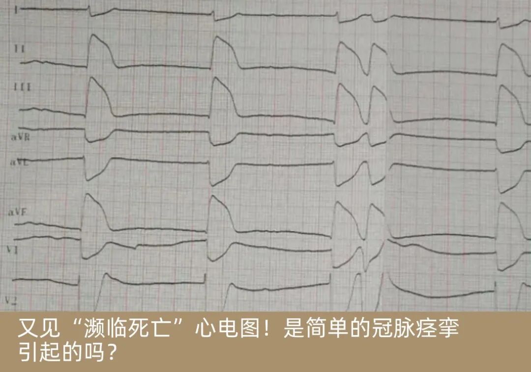 导丝怎么扩收藏：器械难以通过的CTO病变之技术图谱_https://www.jmylbn.com_新闻资讯_第39张