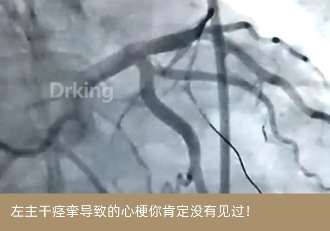 导丝怎么扩收藏：器械难以通过的CTO病变之技术图谱_https://www.jmylbn.com_新闻资讯_第40张