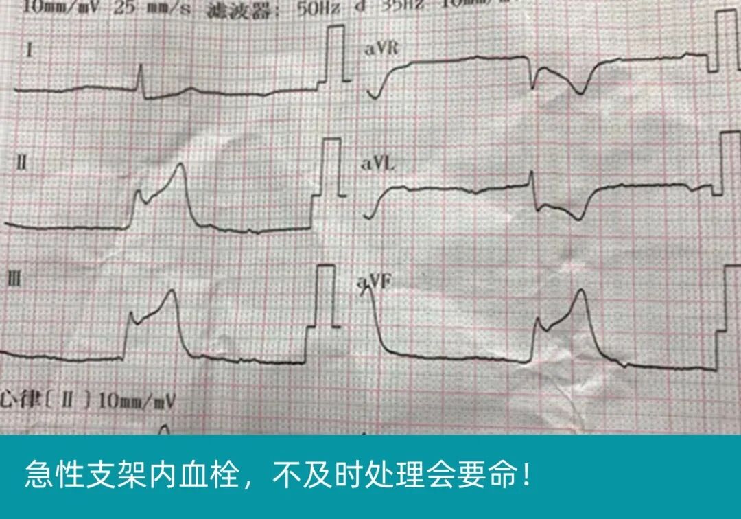 塞球囊怎么取左主干急性闭塞球囊扩张后反复室颤死亡，难道心脏破了？_https://www.jmylbn.com_新闻资讯_第6张