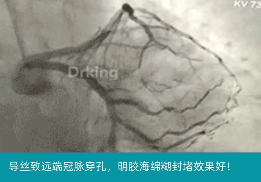 塞球囊怎么取左主干急性闭塞球囊扩张后反复室颤死亡，难道心脏破了？_https://www.jmylbn.com_新闻资讯_第5张