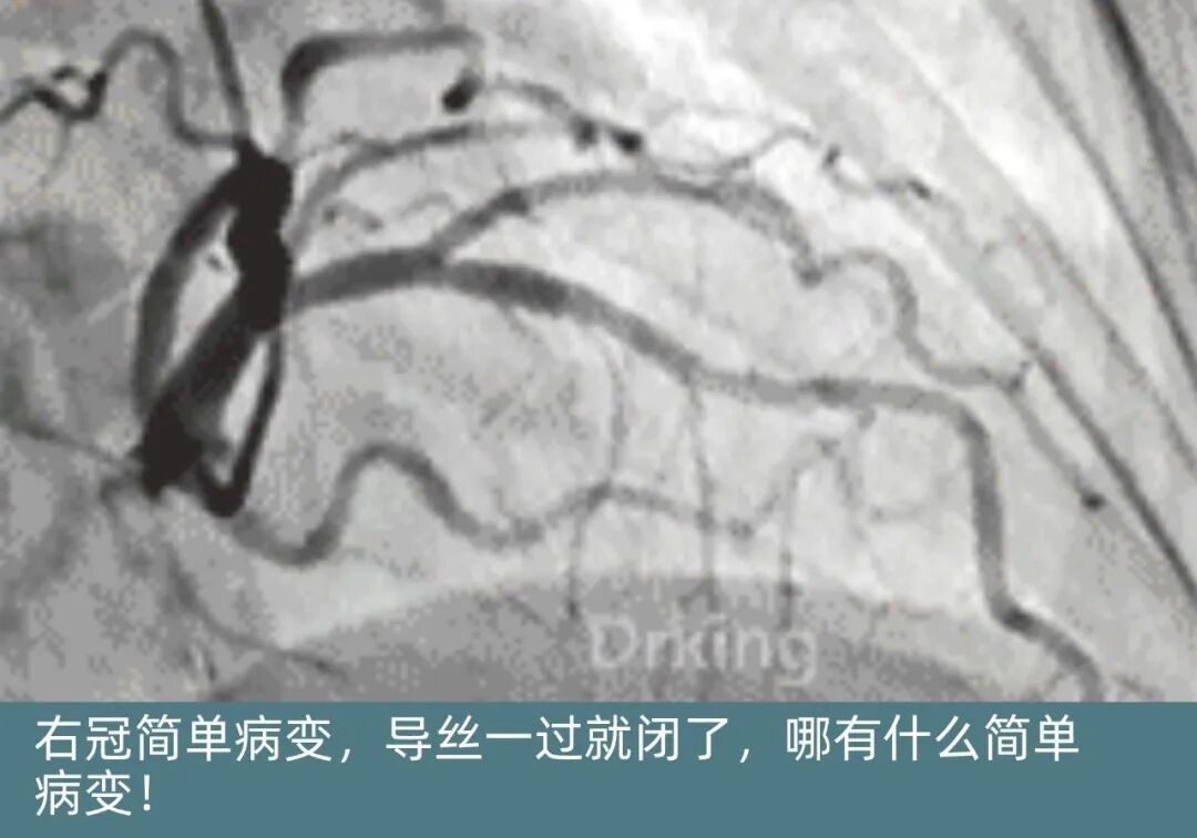 泥鳅导丝怎么用想着容易做着难：演示如何给泥鳅导丝塑“U”弯！_https://www.jmylbn.com_新闻资讯_第12张