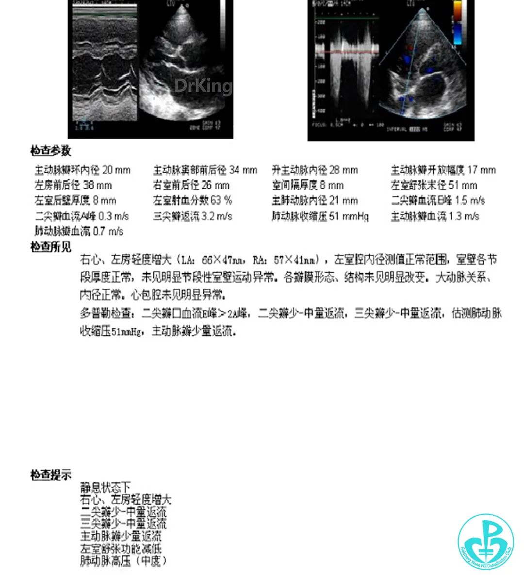 明胶在血管怎么降解并发症丨前降支CTO同侧逆向开通时侧支血管破裂，弹簧圈联合明胶海绵封堵_https://www.jmylbn.com_新闻资讯_第55张