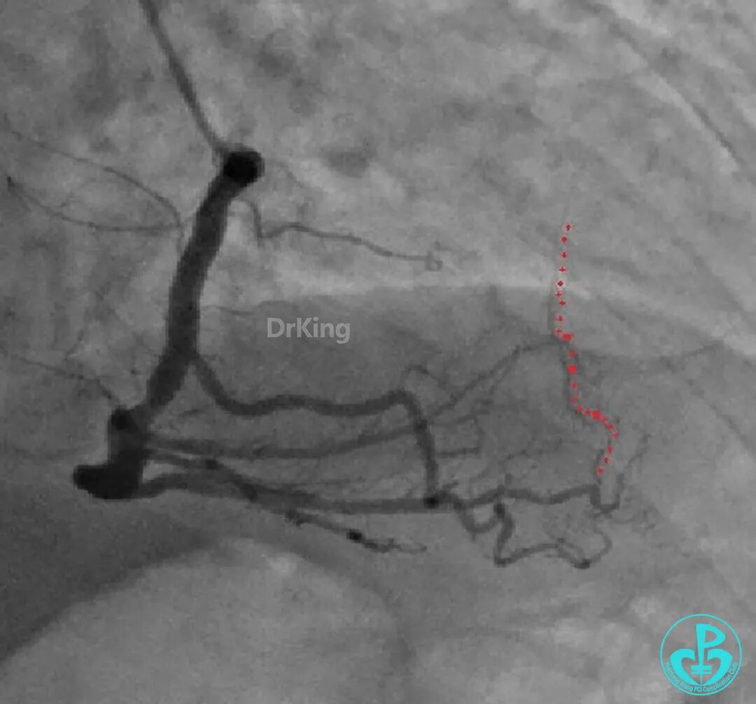 明胶在血管怎么降解并发症丨前降支CTO同侧逆向开通时侧支血管破裂，弹簧圈联合明胶海绵封堵_https://www.jmylbn.com_新闻资讯_第9张