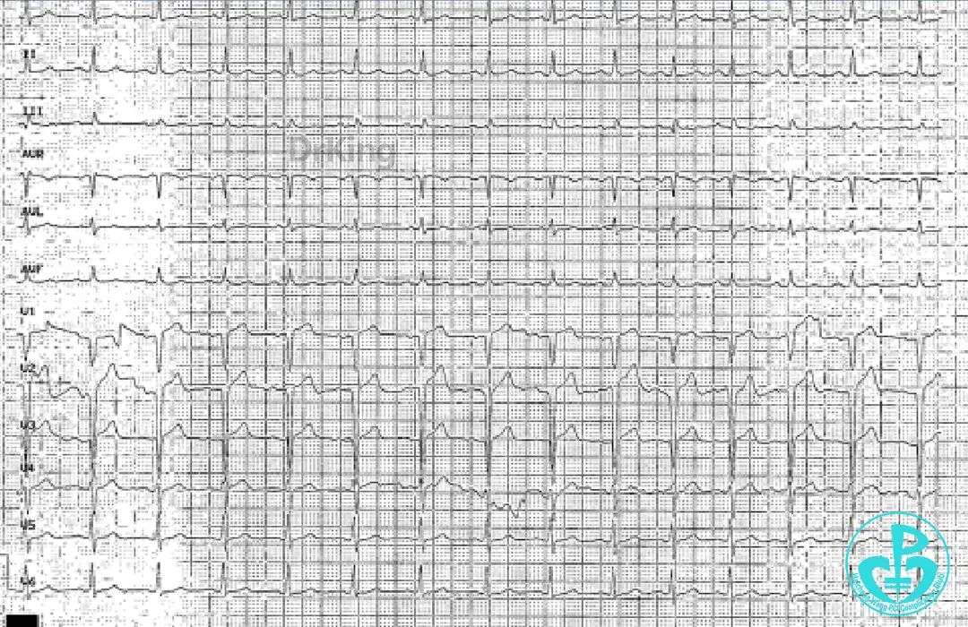 明胶在血管怎么降解并发症丨前降支CTO同侧逆向开通时侧支血管破裂，弹簧圈联合明胶海绵封堵_https://www.jmylbn.com_新闻资讯_第2张