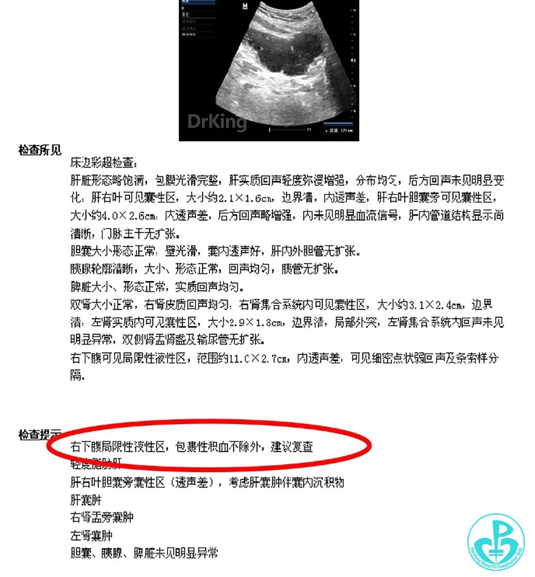 明胶在血管怎么降解并发症丨前降支CTO同侧逆向开通时侧支血管破裂，弹簧圈联合明胶海绵封堵_https://www.jmylbn.com_新闻资讯_第39张