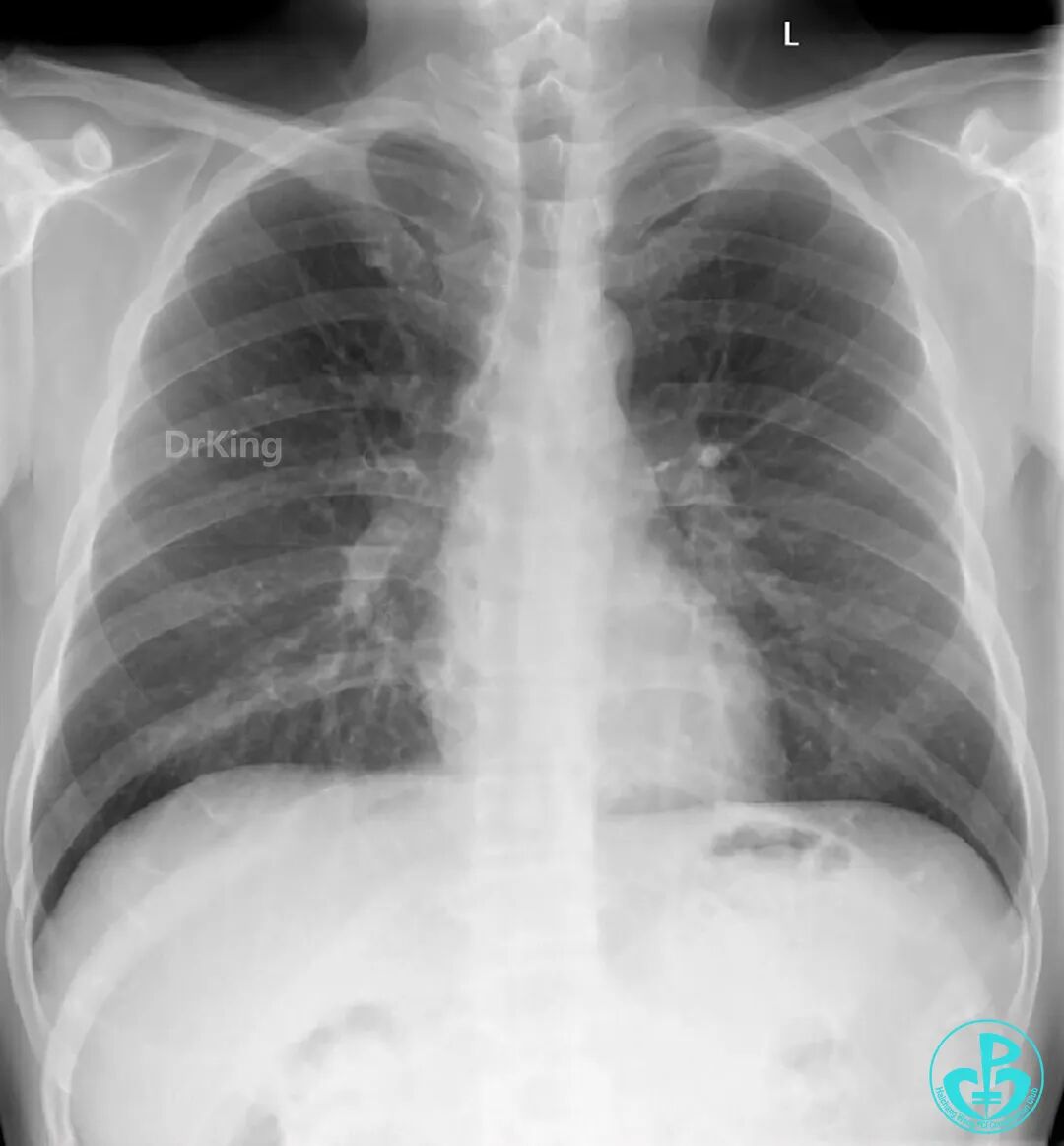 明胶在血管怎么降解并发症丨前降支CTO同侧逆向开通时侧支血管破裂，弹簧圈联合明胶海绵封堵_https://www.jmylbn.com_新闻资讯_第3张