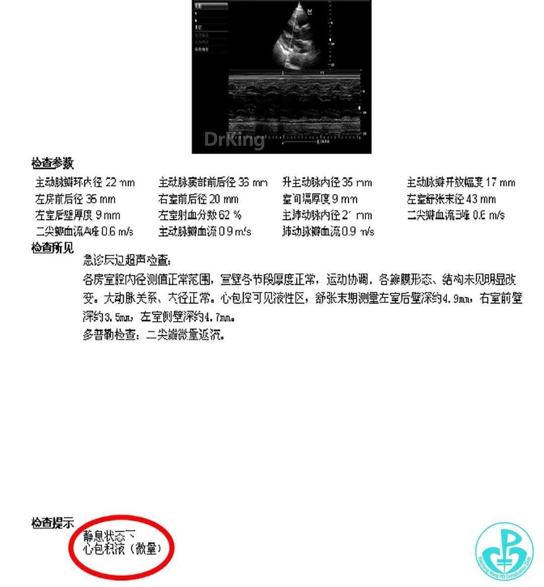 明胶在血管怎么降解并发症丨前降支CTO同侧逆向开通时侧支血管破裂，弹簧圈联合明胶海绵封堵_https://www.jmylbn.com_新闻资讯_第40张