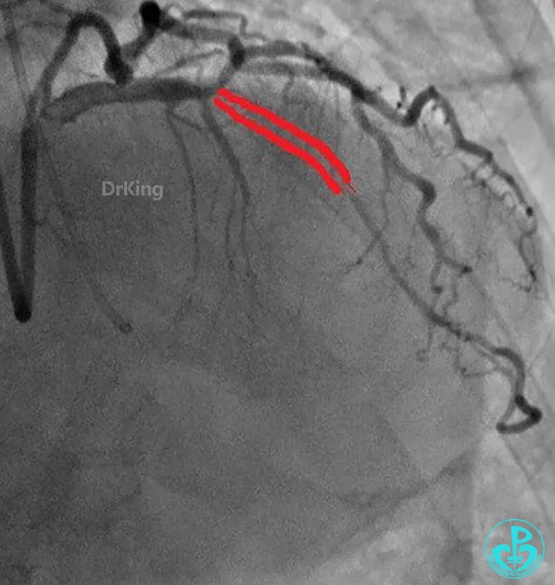 明胶在血管怎么降解并发症丨前降支CTO同侧逆向开通时侧支血管破裂，弹簧圈联合明胶海绵封堵_https://www.jmylbn.com_新闻资讯_第10张