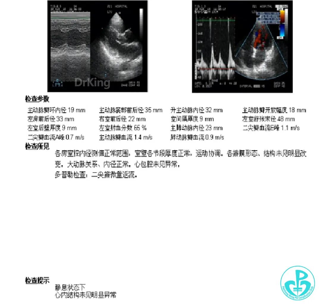 明胶在血管怎么降解并发症丨前降支CTO同侧逆向开通时侧支血管破裂，弹簧圈联合明胶海绵封堵_https://www.jmylbn.com_新闻资讯_第4张