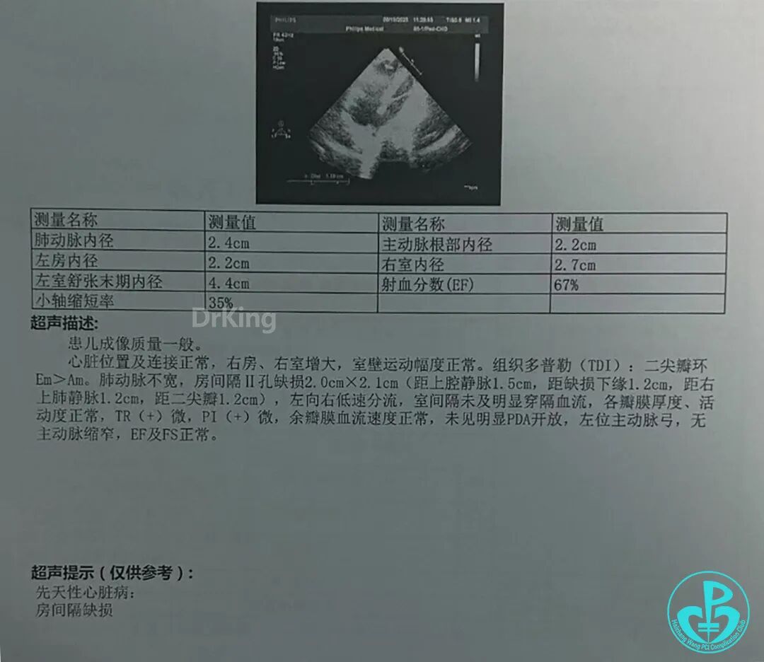 什么是asd封堵可降解ASD封堵器成功封堵儿童21mm的大型房缺病例分享-上海聚慕医疗器械有限公司
