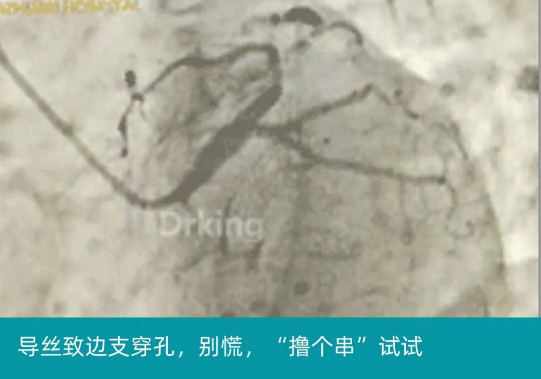 泥鳅导丝怎么用泥鳅导丝又惹祸，股动脉分支破裂要堵上！_https://www.jmylbn.com_新闻资讯_第9张