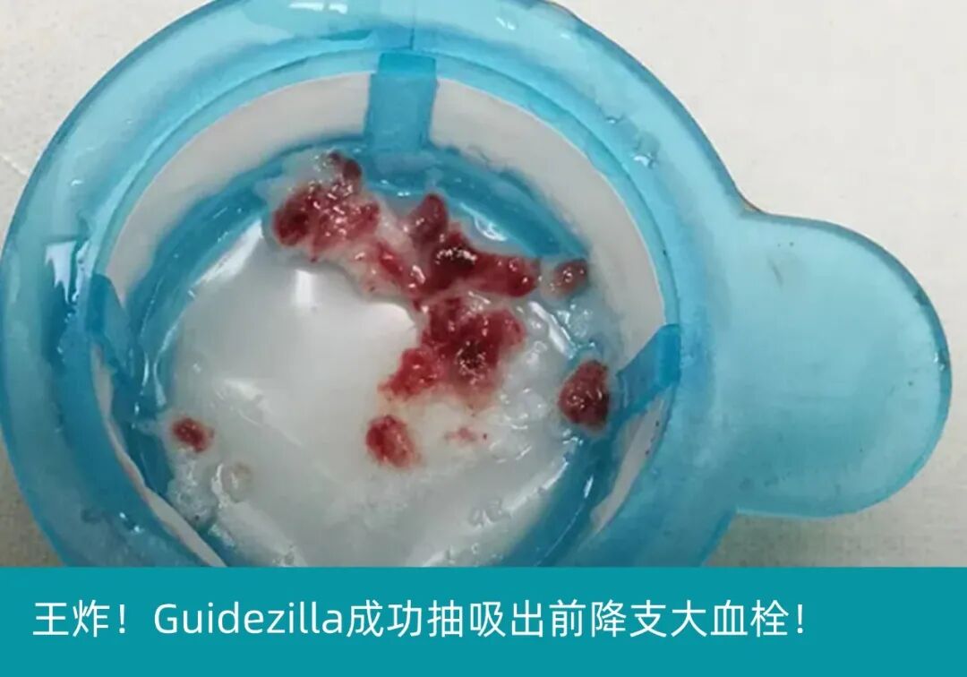 泥鳅导丝怎么用泥鳅导丝又惹祸，股动脉分支破裂要堵上！_https://www.jmylbn.com_新闻资讯_第10张