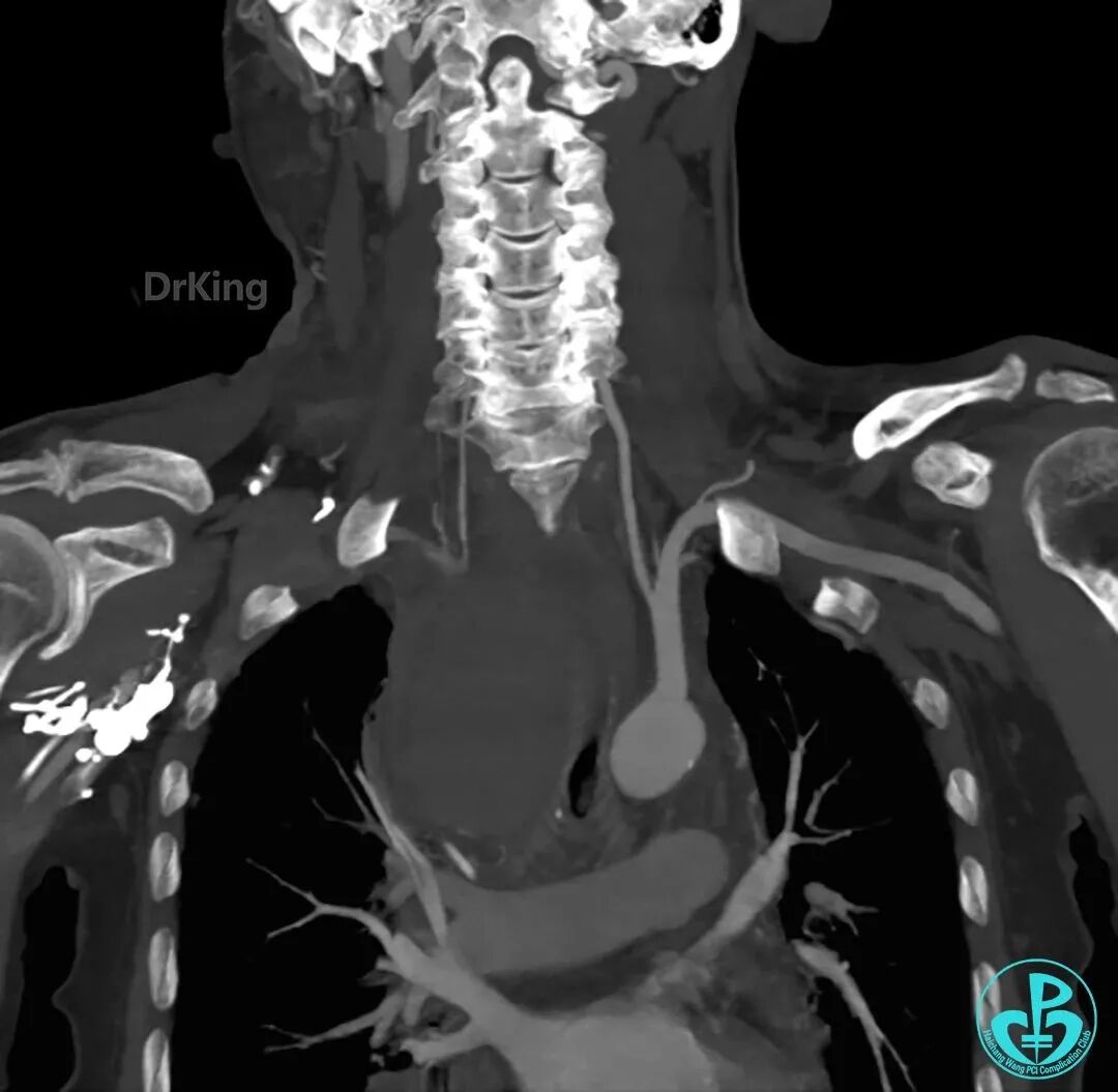 泥鳅导丝怎么用超滑泥鳅导丝致纵隔血肿，保守治疗血肿吸收_https://www.jmylbn.com_新闻资讯_第19张
