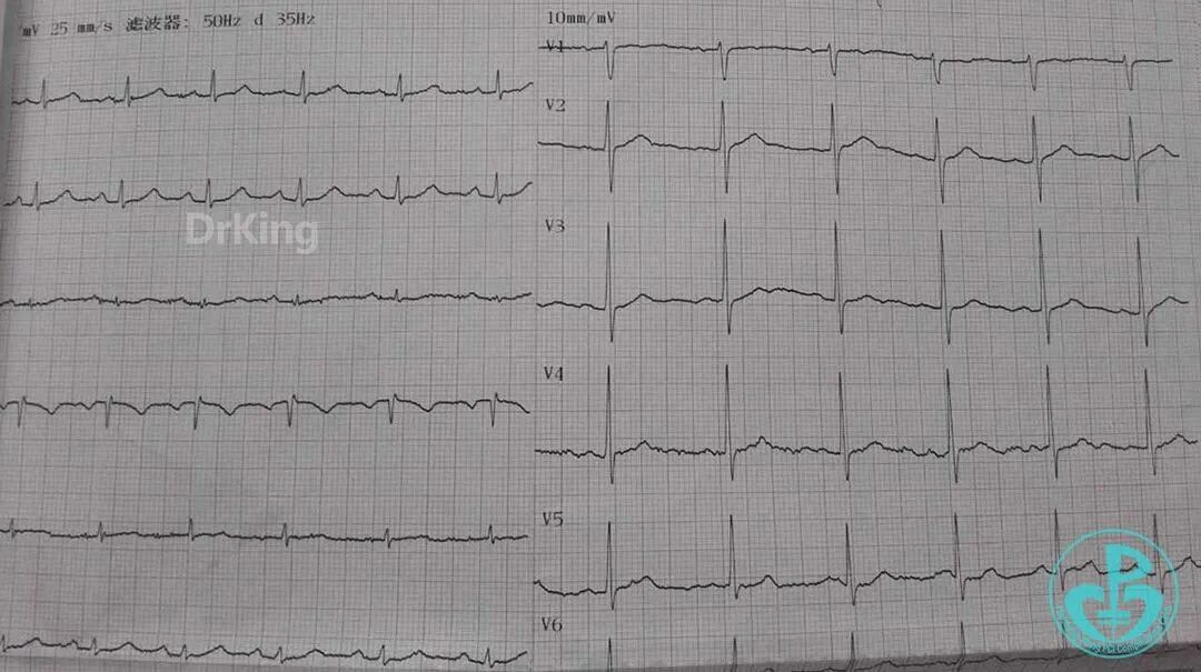 泥鳅导丝怎么用超滑泥鳅导丝致纵隔血肿，保守治疗血肿吸收_https://www.jmylbn.com_新闻资讯_第11张
