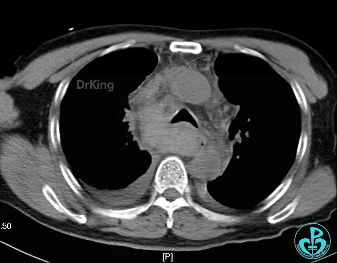 泥鳅导丝怎么用超滑泥鳅导丝致纵隔血肿，保守治疗血肿吸收_https://www.jmylbn.com_新闻资讯_第15张