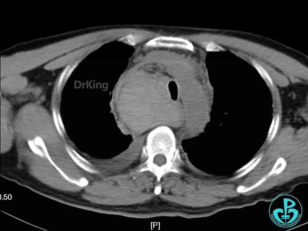 泥鳅导丝怎么用超滑泥鳅导丝致纵隔血肿，保守治疗血肿吸收_https://www.jmylbn.com_新闻资讯_第16张