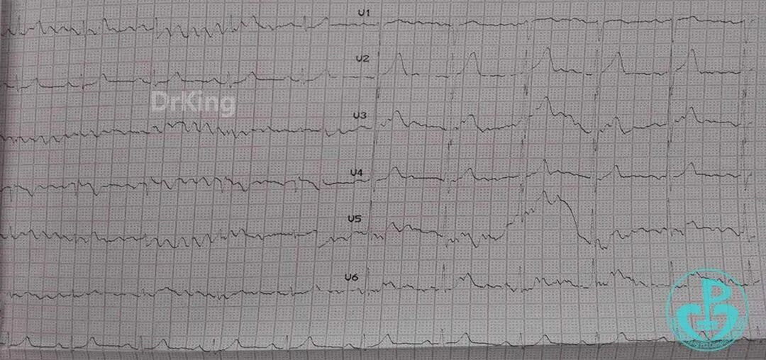 泥鳅导丝怎么用超滑泥鳅导丝致纵隔血肿，保守治疗血肿吸收_https://www.jmylbn.com_新闻资讯_第1张