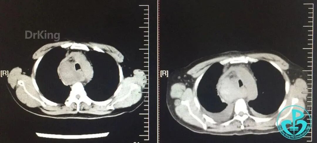 泥鳅导丝怎么用超滑泥鳅导丝致纵隔血肿，保守治疗血肿吸收_https://www.jmylbn.com_新闻资讯_第20张