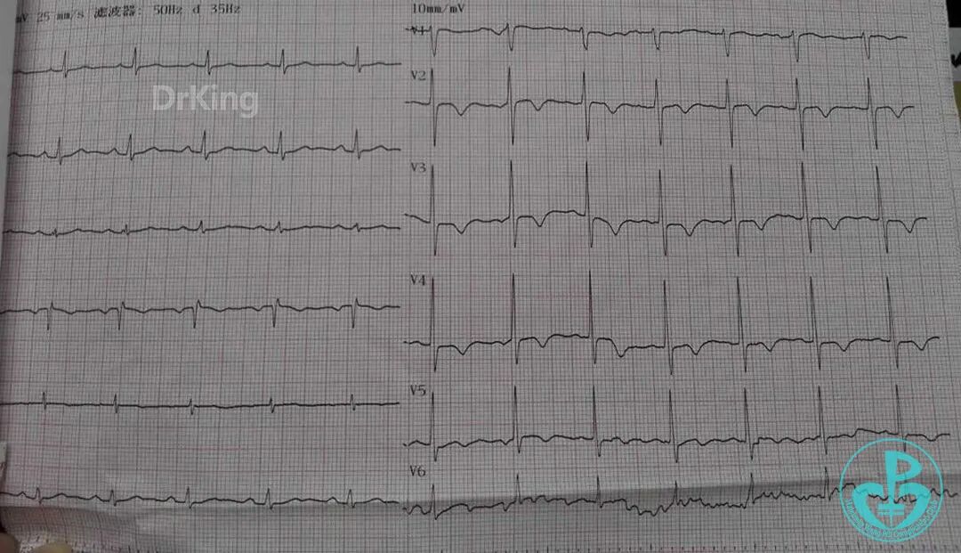 泥鳅导丝怎么用超滑泥鳅导丝致纵隔血肿，保守治疗血肿吸收_https://www.jmylbn.com_新闻资讯_第12张