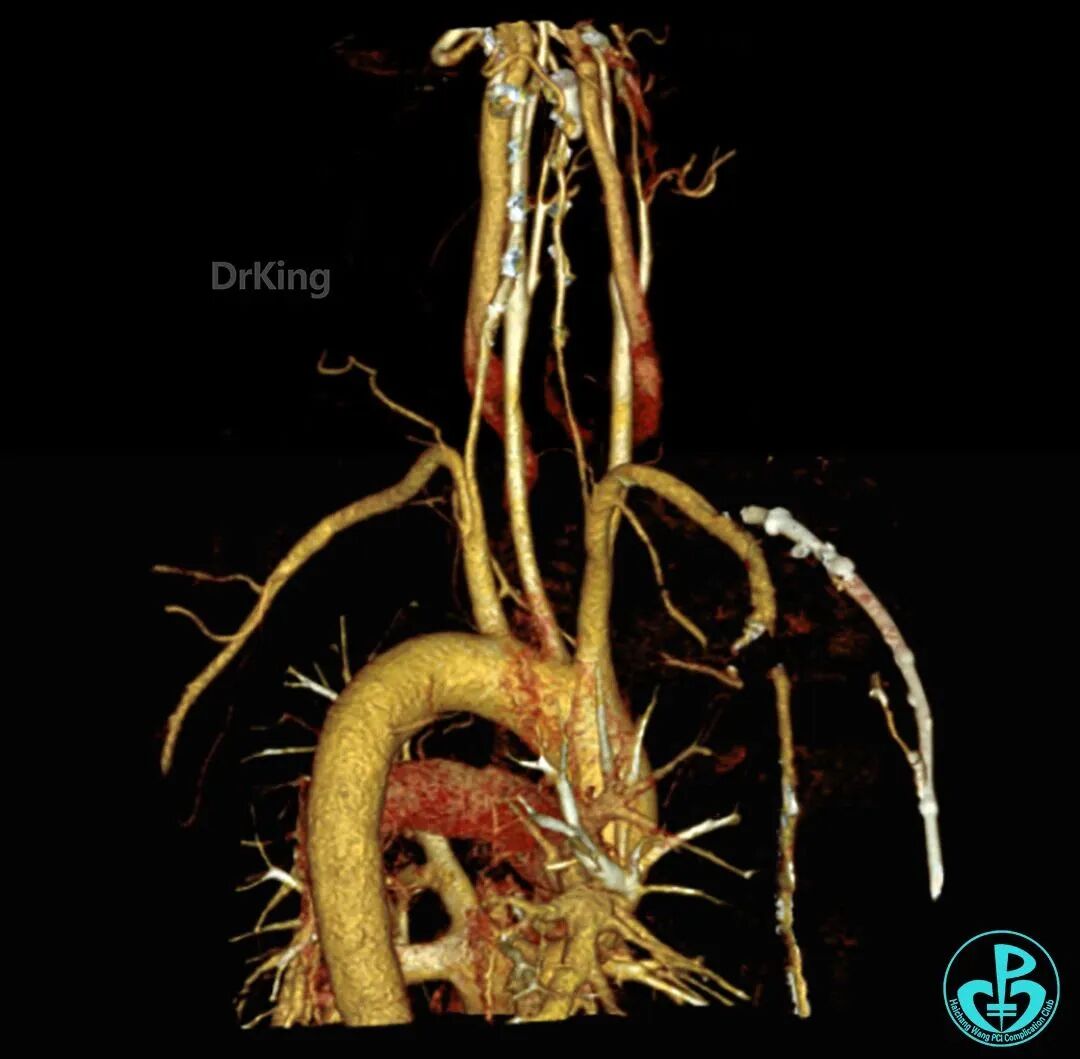 泥鳅导丝怎么用超滑泥鳅导丝致纵隔血肿，保守治疗血肿吸收_https://www.jmylbn.com_新闻资讯_第18张