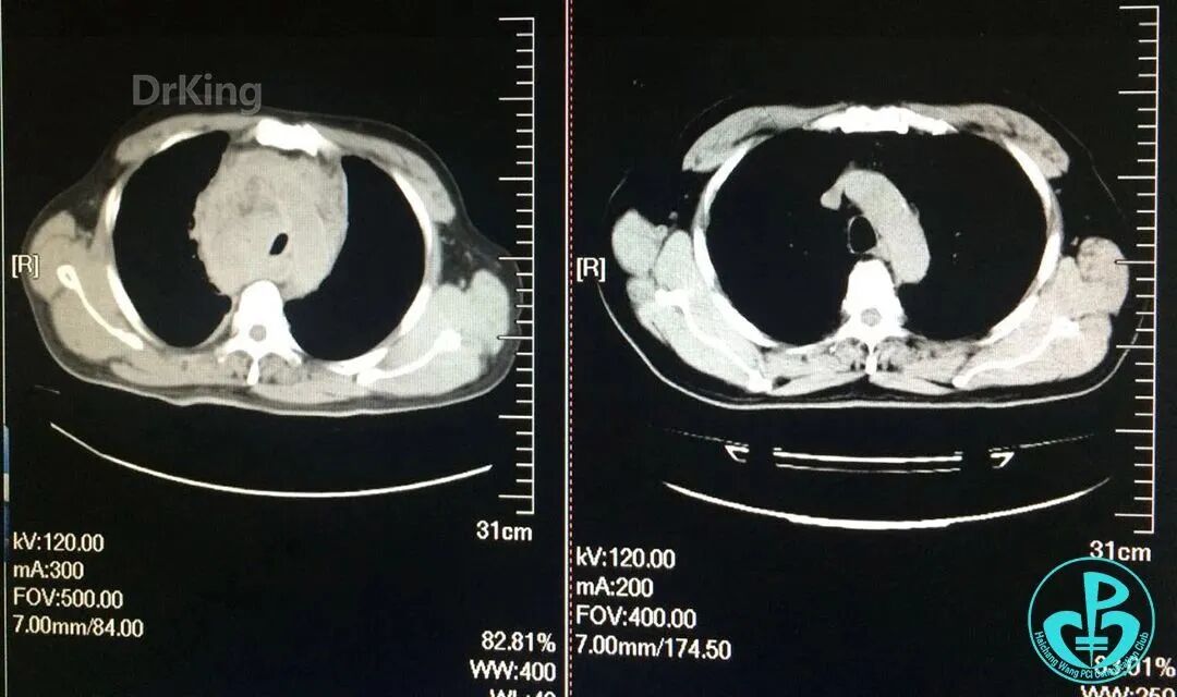 泥鳅导丝怎么用超滑泥鳅导丝致纵隔血肿，保守治疗血肿吸收_https://www.jmylbn.com_新闻资讯_第14张
