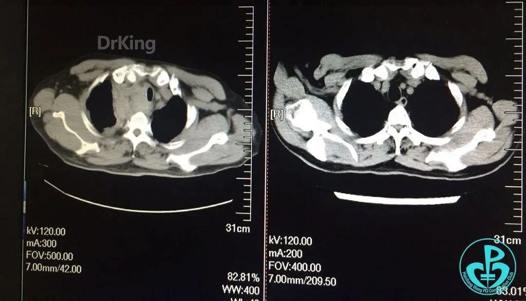 泥鳅导丝怎么用超滑泥鳅导丝致纵隔血肿，保守治疗血肿吸收_https://www.jmylbn.com_新闻资讯_第13张