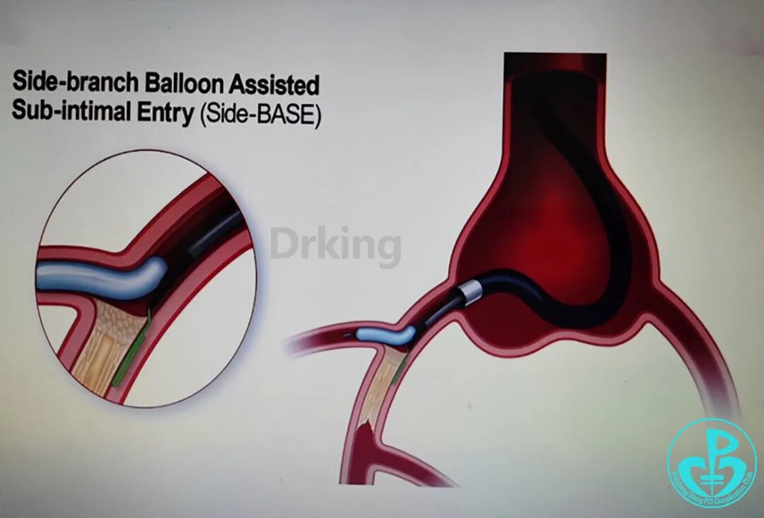 导丝怎么扩收藏：器械难以通过的CTO病变之技术图谱_https://www.jmylbn.com_新闻资讯_第37张
