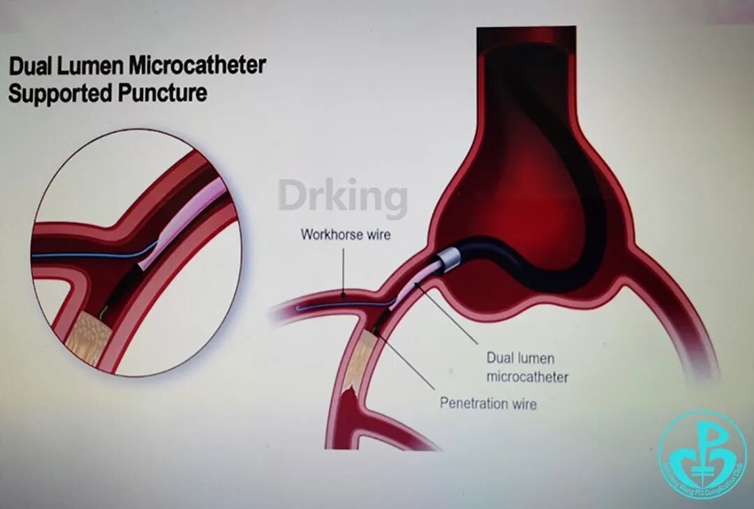 导丝怎么扩收藏：器械难以通过的CTO病变之技术图谱_https://www.jmylbn.com_新闻资讯_第36张