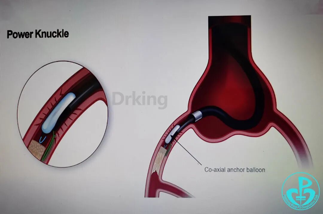 导丝怎么扩收藏：器械难以通过的CTO病变之技术图谱_https://www.jmylbn.com_新闻资讯_第35张