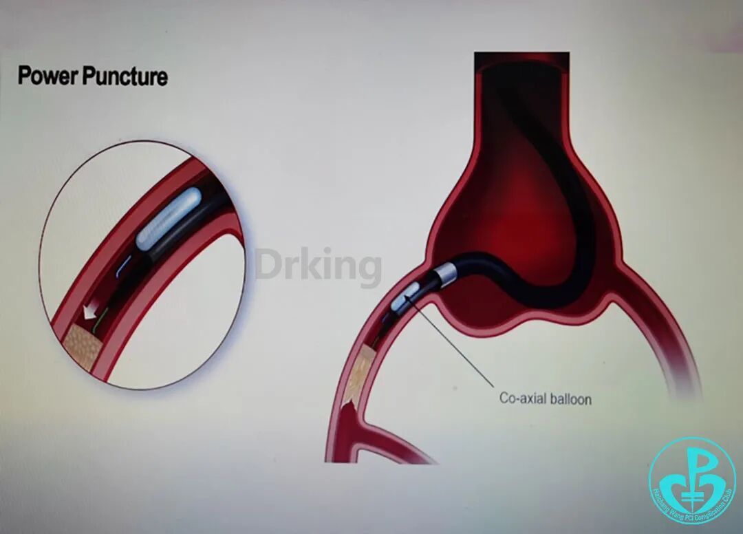 导丝怎么扩收藏：器械难以通过的CTO病变之技术图谱_https://www.jmylbn.com_新闻资讯_第32张