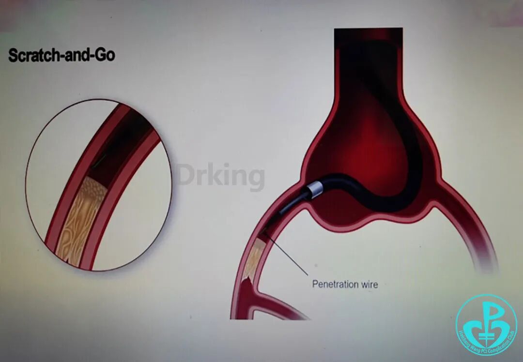 导丝怎么扩收藏：器械难以通过的CTO病变之技术图谱_https://www.jmylbn.com_新闻资讯_第33张