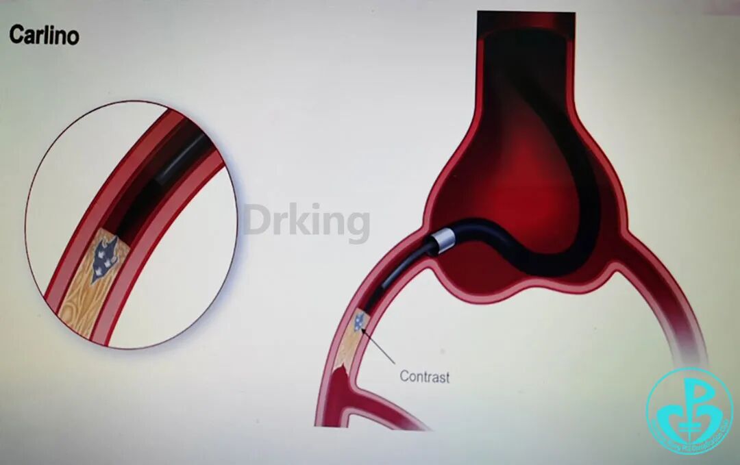 导丝怎么扩收藏：器械难以通过的CTO病变之技术图谱_https://www.jmylbn.com_新闻资讯_第38张