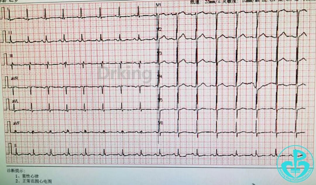 导丝怎么扩收藏：器械难以通过的CTO病变之技术图谱_https://www.jmylbn.com_新闻资讯_第1张