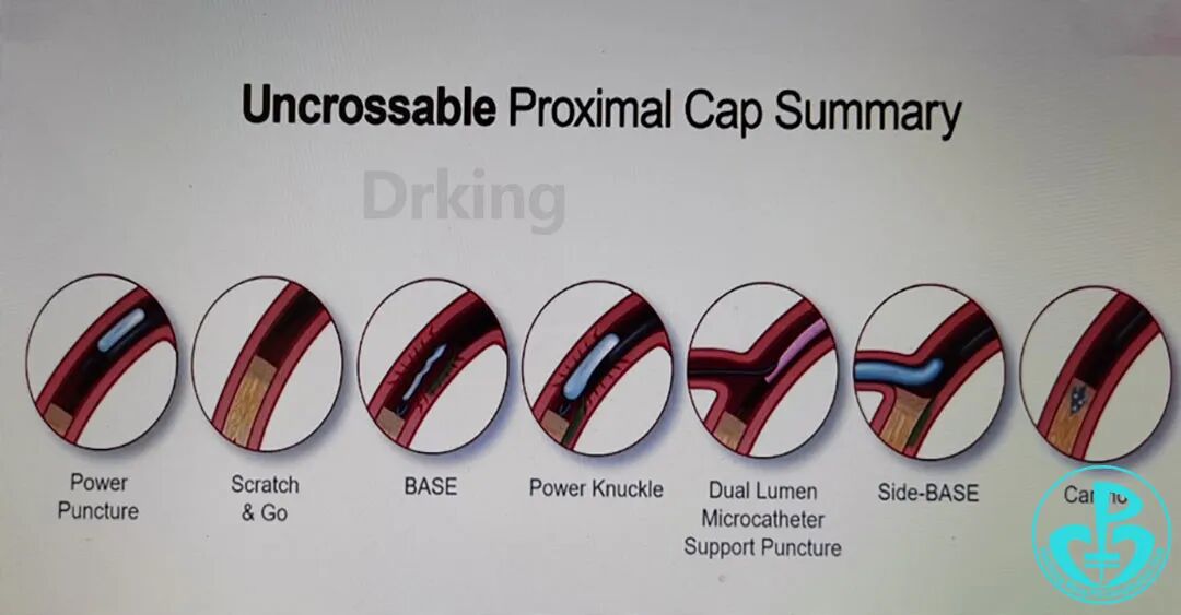 导丝怎么扩收藏：器械难以通过的CTO病变之技术图谱_https://www.jmylbn.com_新闻资讯_第31张