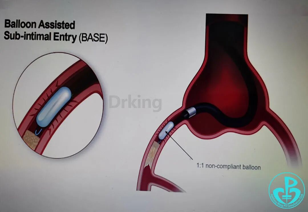 导丝怎么扩收藏：器械难以通过的CTO病变之技术图谱_https://www.jmylbn.com_新闻资讯_第34张