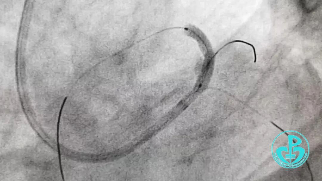 用30ml造影剂完成复杂pci，我们做到了！