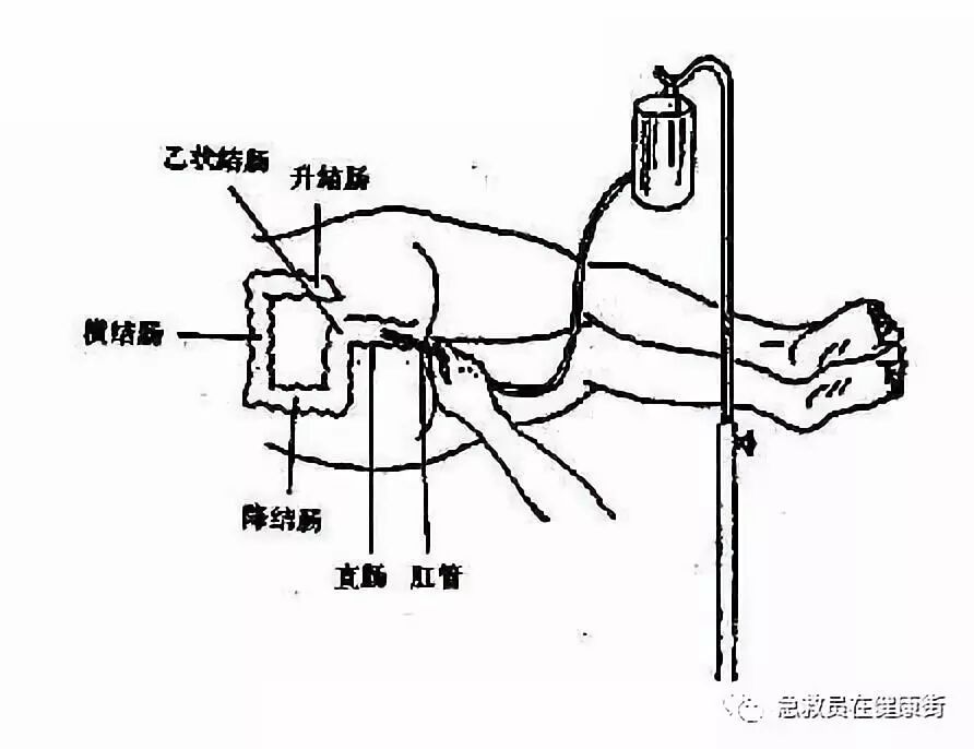怎么无器材灌肠灌肠术（一）_https://www.jmylbn.com_新闻资讯_第1张