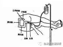 怎么无器材灌肠灌肠术（一）_https://www.jmylbn.com_新闻资讯_第22张