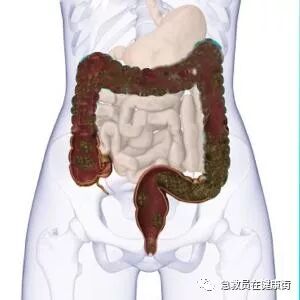 怎么无器材灌肠灌肠术（一）_https://www.jmylbn.com_新闻资讯_第26张