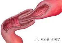 怎么无器材灌肠灌肠术（一）_https://www.jmylbn.com_新闻资讯_第5张