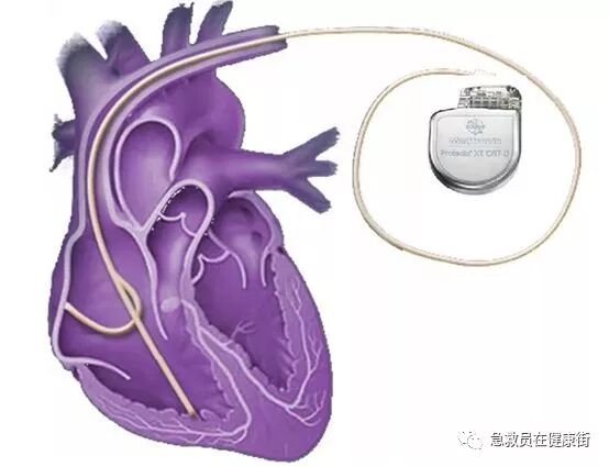 电位疏导器怎么使用心脏起搏器植入术（一）_https://www.jmylbn.com_新闻资讯_第2张