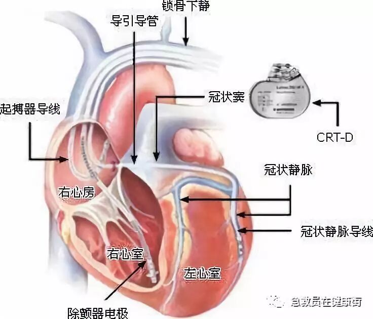 电位疏导器怎么使用心脏起搏器植入术（一）_https://www.jmylbn.com_新闻资讯_第7张