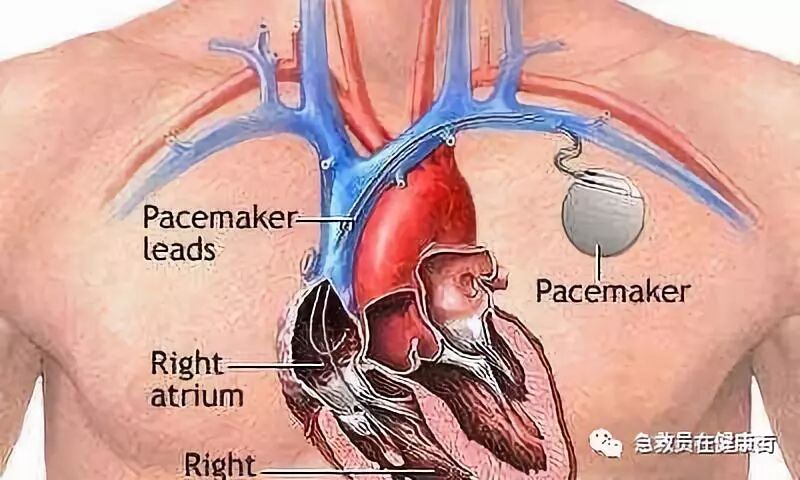 电位疏导器怎么使用心脏起搏器植入术（一）_https://www.jmylbn.com_新闻资讯_第15张