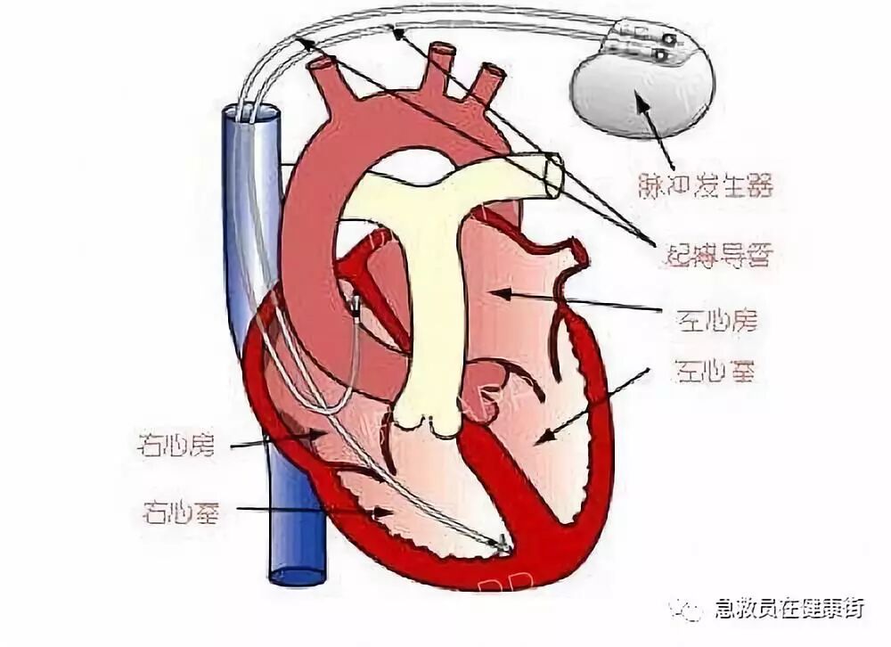 电位疏导器怎么使用心脏起搏器植入术（一）_https://www.jmylbn.com_新闻资讯_第13张