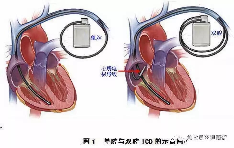 电位疏导器怎么使用心脏起搏器植入术（一）_https://www.jmylbn.com_新闻资讯_第10张
