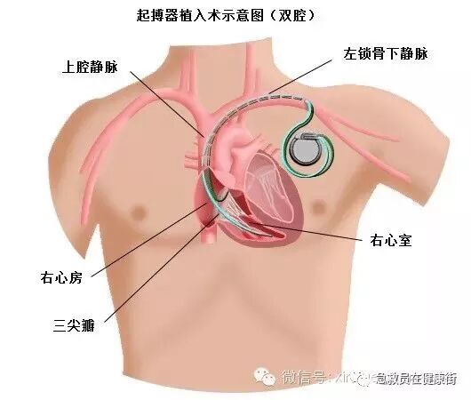 电位疏导器怎么使用心脏起搏器植入术（一）_https://www.jmylbn.com_新闻资讯_第11张