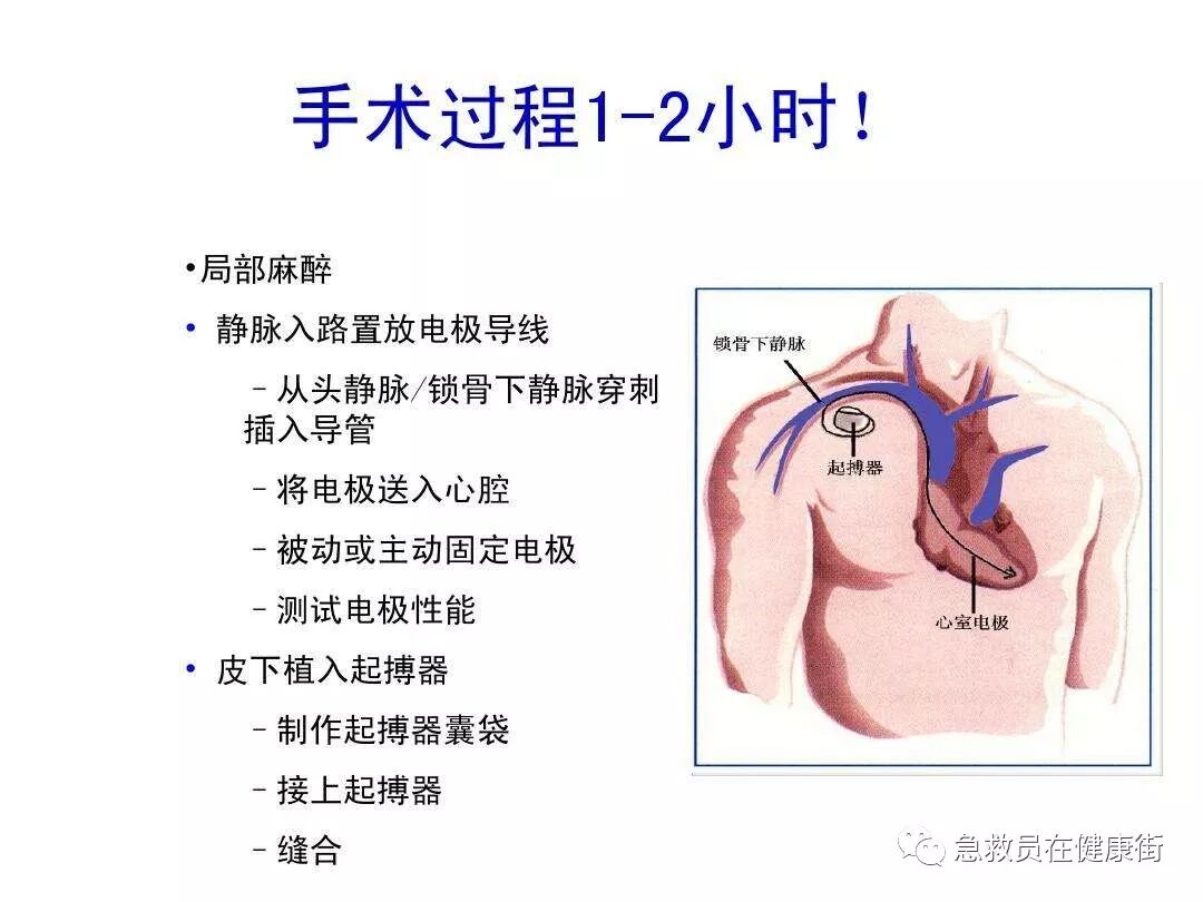 电位疏导器怎么使用心脏起搏器植入术（一）_https://www.jmylbn.com_新闻资讯_第9张