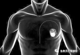 电位疏导器怎么使用心脏起搏器植入术（一）_https://www.jmylbn.com_新闻资讯_第16张