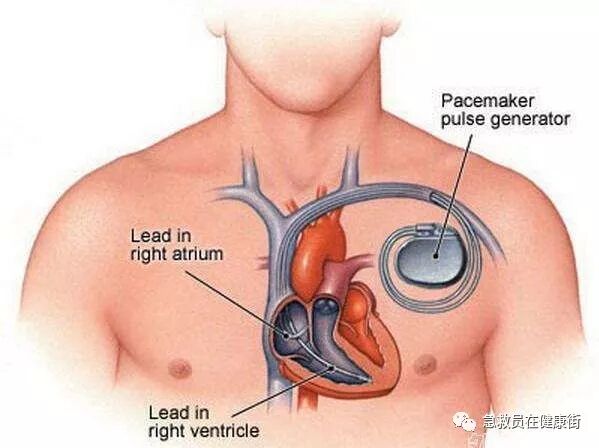 电位疏导器怎么使用心脏起搏器植入术（一）_https://www.jmylbn.com_新闻资讯_第1张