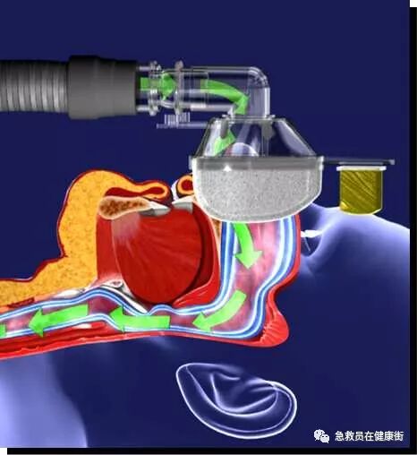 epap什么模式无创呼吸机（二）_https://www.jmylbn.com_新闻资讯_第24张